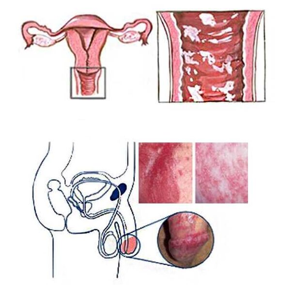 candidiasis alat kelamin wanita dan lelaki sebagai punca pelepasan patologi